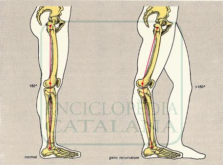 Bien se positionner au yoga : illustration de l'hypertension du genou